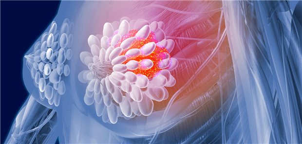 Bei Frauen mit metastasiertem triple-negativem Mammakarzinom verbessert ein neues Antibody Drug Conjugate (ADC) die Prognose.