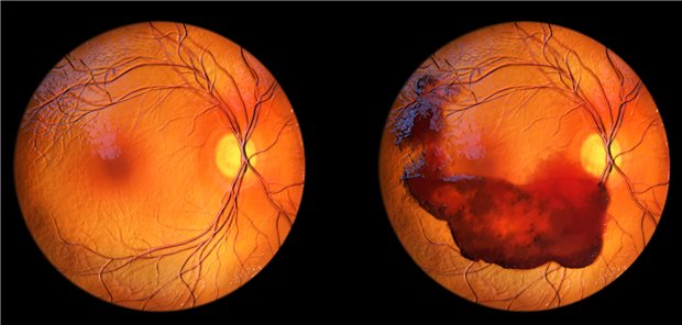 Bei einer Glaskörperblutungen bei Kindern ist es wichtig, ein Schütteltrauma durch körperliche Misshandlung als Ursache zu erkennen und im Verdachtsfall gleich die Pädiatrie einzuschalten. (Symbolbild)