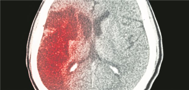 Schlaganfall: Das sind Grenzfälle der Thrombolyse Bei Grenzentscheidungen (z.B. kürzlich stattgehabte Operation) gelte es, Rücksprache mit der entsprechenden Fachdisziplin zu halten, betont Dr. Milani Deb-Chatterji.