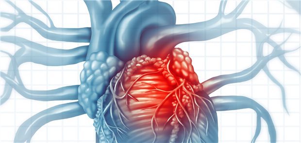 Bei Herzinsuffizienz soll laut Leitlinien eine Therapie mit vier Standardmedikamenten angestrebt werden.
