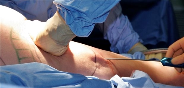 Bei Liposuktionen auf Kasse agieren Krankenhäuser nach einem Urteil des Bundessozialgerichtes nun in einem weiteren Spielfeld als vorher.