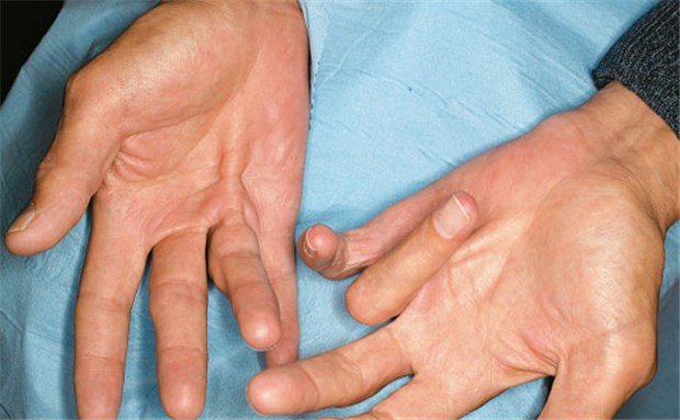 Strahlen gegen Streckhemmung der Finger Bei M. Dupuytren bilden sich Bindegewebsstränge, die einzelne Sehnen ummanteln.