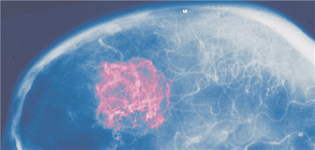 Bei Melanommetastasen im Hirn könnte eine Immuntherapie eine mögliche Alternative zu Operation oder Bestrahlung sein.