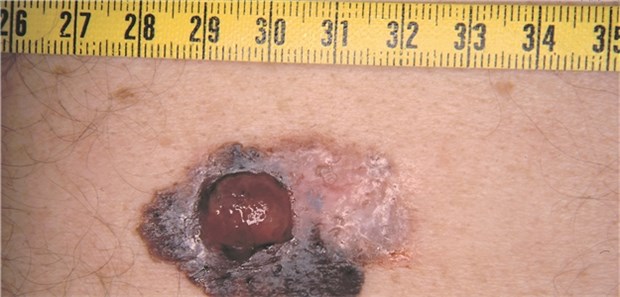 Bei Melanompatienten wird die Radiotherapie in Kombination mit Checkpointblockern geprüft.