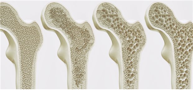 Bei Osteoporose kommen häufig orale Bisphosphonate oder der monoklonale Antikörper Denosumab zum Einsatz. Möglicherweise hat dies auch einen Einfluss darauf, ob die Patienten an Diabetes erkranken.