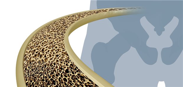 Bei Osteoporose sollte das Ziel sein, die Knochendichte so stark wie möglich zu steigern. Hier setzt man auf knochenaufbauende und antiresorptive Therapien.