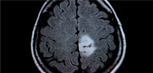 Bei Patienten mit Hirnmetastasen war eine Immuntherapie mit zusätzlicher Radiotherapie mit einer um 10,4 Monate längeren Restlebenszeit verknüpft.