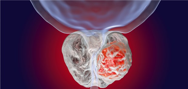 Bei Patienten mit Prostatakarzinom eignen sich Statine möglicherweise als adjuvante Therapie.