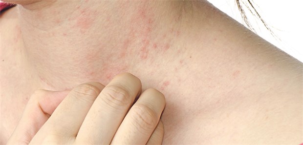 Hauterkrankung schlägt aufs Gemüt Bei Patienten mit Psoriasis war die Rate für Angststörungen fast um das Dreifache erhöht.