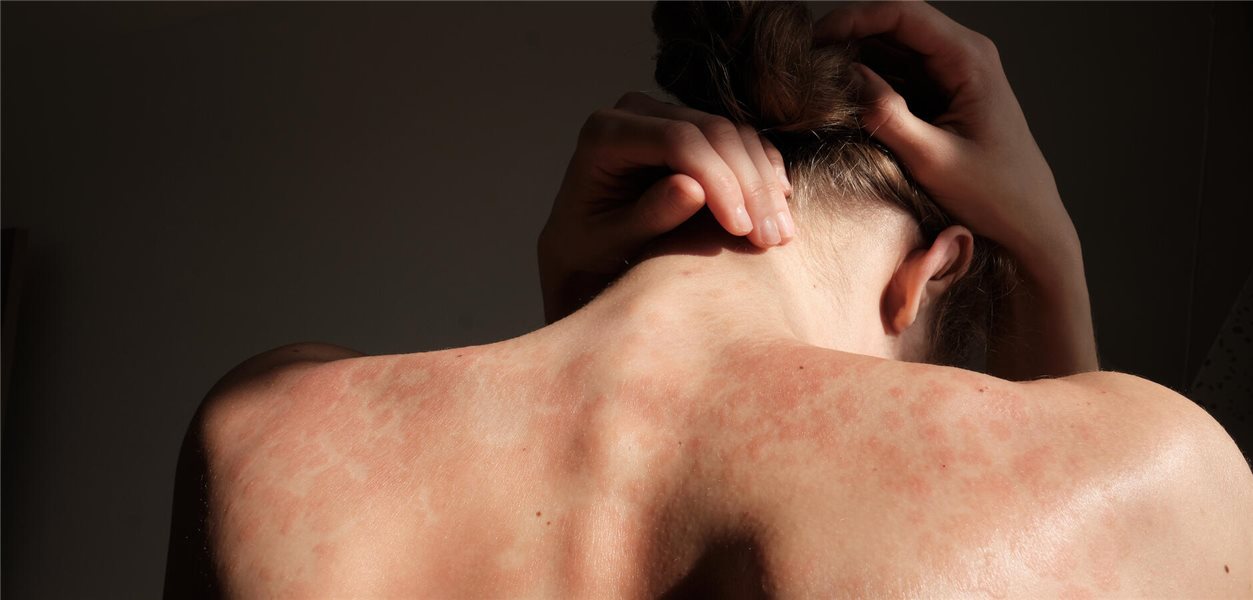 Für den Praxiseinsatz : Komorbiditäten bei Psoriasis: Checkliste zur ...