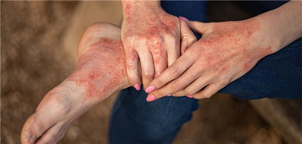 Bei Patienten mit atopischer Dermatitis sind die kutanen Vitamin-C-Spiegel reduziert.