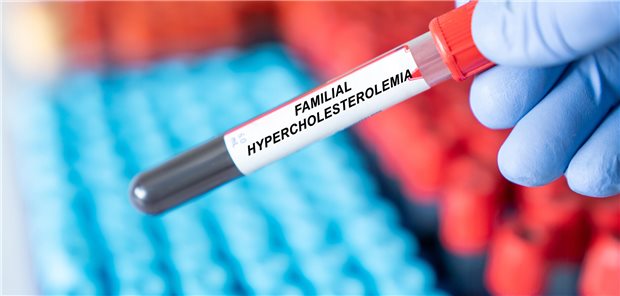 Ein Laborröhrchen mit Blut, das auf familiäre Hypercholesterinämie getestet wird.