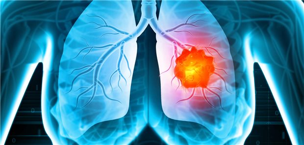 Medizinische Illustration mit Lungenkrebs oder Bronchialkarzinom.