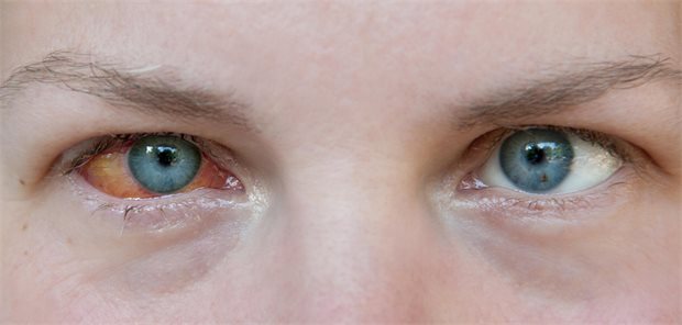 Ein Mann mit einem roten Auge.