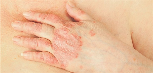 Psoriasis-Arthritis kündigt sich manchmal Jahre vorher an Bei Psoriasis ist nach einigen Jahren auch mit einer Arthritis zu rechnen.