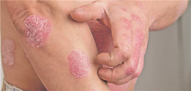 Bei Psoriasis sind Lokaltherapeutika oft die Behandlungsmittel der ersten Wahl.