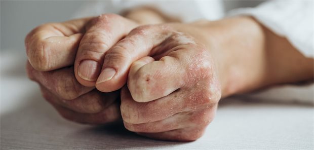 Hände mit Psoriasis.