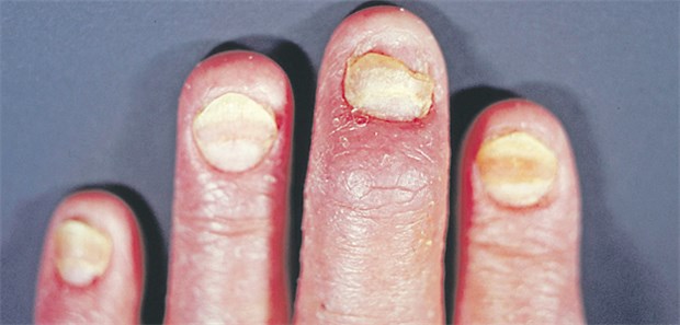 Tabuthema Genitalsymptome Bei Psoriasispatienten sind nicht nur die Hände Prädilektionsstellen, auch der Genitalbereich ist oft befallen.