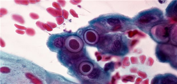 Zusatzhonorar für erfolgreiche Beratung zum Chlamydienscreening Bei Schwangerschaft nur ungern gesehen: Chlamydia trachomatis in Epithelzellen der Gebärmutterschleimhaut, vergrößert im Verhältnis 252:1. Gladden W. Willis / Okapia / picture alliance