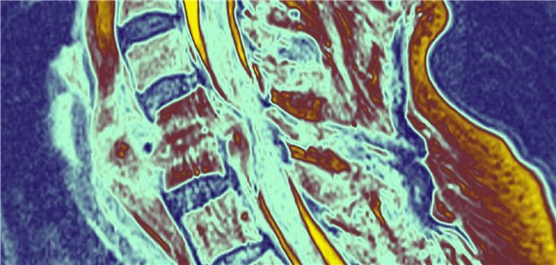 Bei Spinalkanalstenose führt eine Op nicht bei allen Patienten zu einer Besserung.