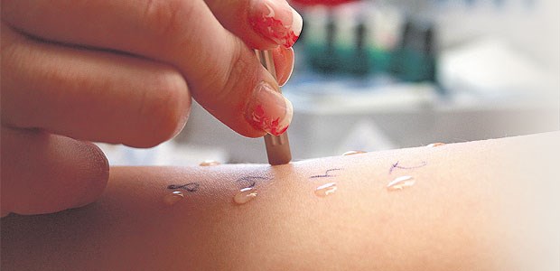 Ärzte bei Diagnostik oft uneins Bei Verdacht auf eine allergische Rhinitis schafft der Pricktest rasch Klarheit.