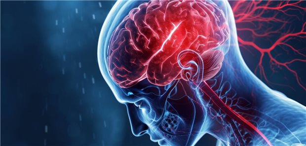Bei Vorliegen von CYP-Genotypen, die mit einer eingeschränkten Stoffwechselkapazität verbunden sind, kann die antithrombotische Wirkung von Clopidogrel (Prodrug) unzureichend sein.