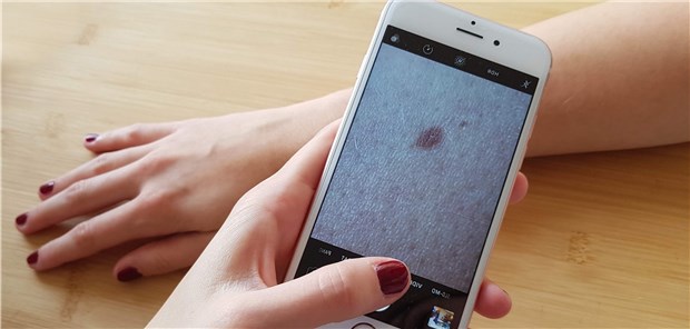 Bei auffälligen Hautflecken können sich Patienten eine erste Einschätzung von Fachärzten per App holen.