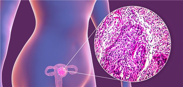 Bei bestimmten gynäkologischen Tumoren führt eine stereotaktische Strahlentherapie zu einer guten Lokalkontrolle mit minimaler Toxizität. (Symbolbild)