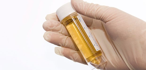 Vielversprechende Ergebnisse mit Urin-Schnelltest Bei dem neuen Test wird eine verdünnte Urinprobe des Patienten in das Probenfenster einer Testkassette pipettiert.