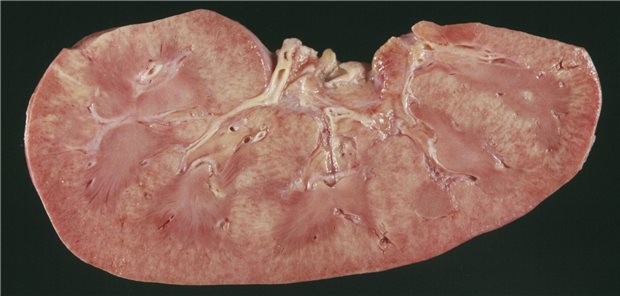 Geht an die Nieren: AA-Amyloidose Ein Bild einer Niere mit Amyloidose, Längsschnitt.