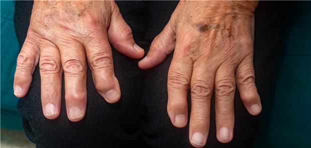 Nahaufnahme der Hände einer Person mit Fingerpolyarthrose (FPA).