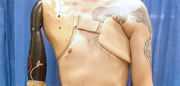 Künstlicher Arm bald so gut wie biologischer Bei der Armprothese ist der Oberarm über einenb Ellenbogen aus Plastik und Metall mit dem ebenfalls künstlichen Unterarm verbunden