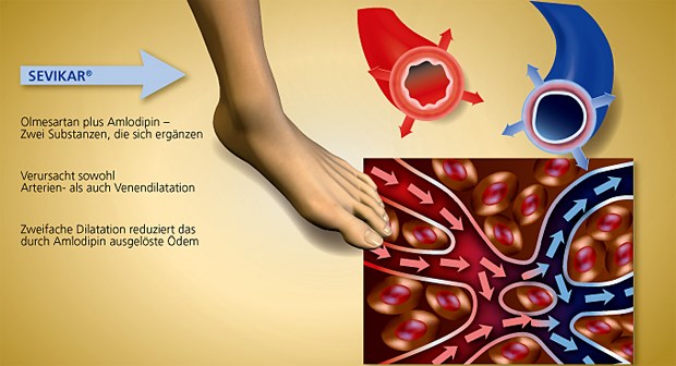 Bei der Blutdrucksenkung Partner, bei Ödemen Gegenspieler: Olmesartan wirkt den durch Amlodipin ausgelösten Knöchelödemen aufgrund seiner vaskulären Effekte entgegen.