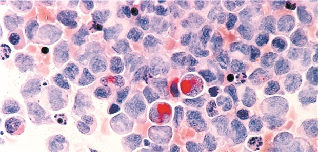 Hat die Chemo auch bei CLL ausgedient? Bei der CML ist gezielte Hemmung von Signalwegen schon längst etabliert.