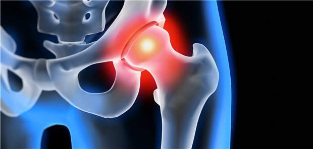 Bei der Implantation künstlicher Hüft- oder Kniegelenke gab es laut AOK-Gesundheitsnavigator zwischen den Kliniken nach wie vor deutliche Unterschiede.