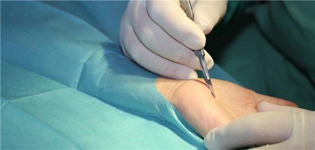 Bei der Karpaltunnel-Release-Operation wird das Retinaculum flexorum unter Schonung des Mittelhandnerven und der dort verlaufenden Sehnen vollständig durchtrennt.