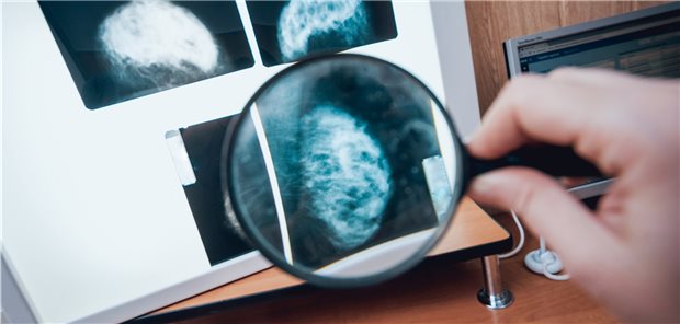 Künstliche Intelligenz unterstützt Pathologen bei Tumor-Suche Bei der Tumordiagnostik müssen Ärzte bisher in der Regel selbst Hand anlegen. KI könnte hier in der Mustererkennung eine deutliche Entlastung für sie darstellen.