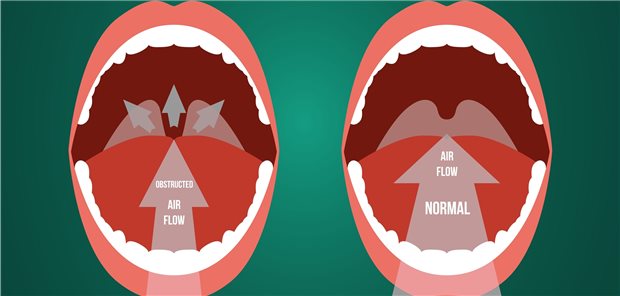 Bei der Uvulopalatopharyngoplastik (UPPP) wird Weichteilgewebe (gekennzeichnet mit Pfeilen) aus dem Nasen-Rachen-Raum operativ entfernt.