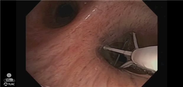 Bei der bronchialen Thermoplastie wird mit Hilfe von lokal applizierter Wärme die glatte Atemwegsmuskulatur reduziert.