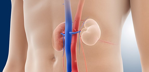 Immunsuppression bremst Funktionsverlust Bei der idiopathischen membranösen Glomerulonephritis geht man inzwischen von einer autoimmunen Pathogenese aus.