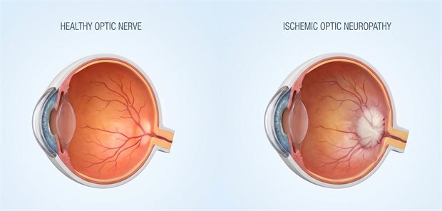 Schematisches Bild eines normalen Optikusnerven und eines Optikusnerven bei Neuropathie