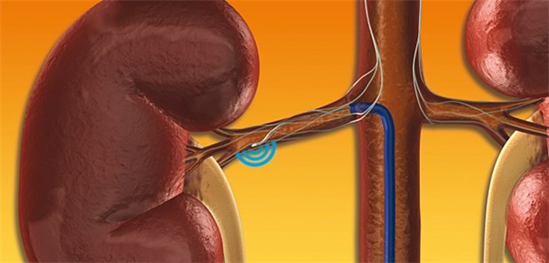 Letzter Ausweg Denervation Bei der renalen Denervation werden Nervenfasern in der Wand der Nierenarterien mit einem Katheter verödet.