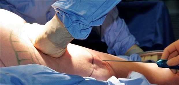 Liposuktion hat in der Klinik nichts verloren Bei der stationären Liposuktion auf Kasse haben betroffene Patienten bisher eher schlechte Karten.