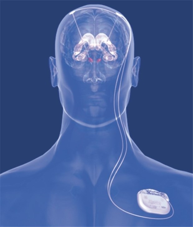 Störfeuer von Impulsen gegen schwere Depressionen Bei der tiefen Hirnstimulation (THS) werden Elektroden in Hirnregionen implantiert, die Impulse von einem Schrittmacher erhalten.