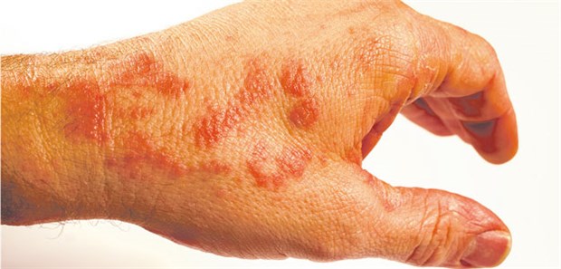 Sechs Kategorien genügen zur Diagnostik Bei einem Ekzem an der Hand ändert sich das klinische Bild im Laufe der Erkrankung oft stark.