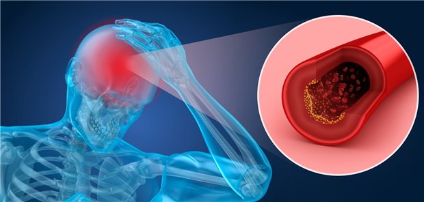 Bei einem Schlaganfall bietet sich die endovaskuläre Therapie nicht nur an großen, proximalen Hirngefäßen an, auch distale Verschlüsse mittelgroßer Gefäße eignen sich.