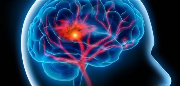 Bei einem Schlaganfall muss schon die Früh-Reha optimal genutzt werden.