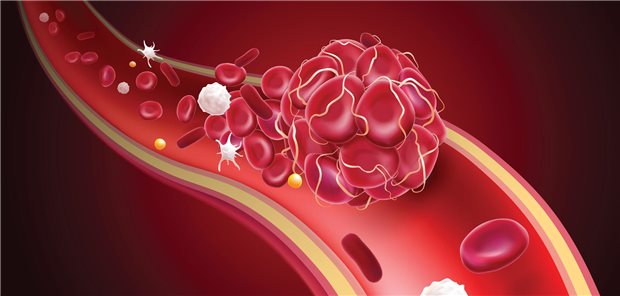 Modell eines Thrombus in einem Blutgefäß.