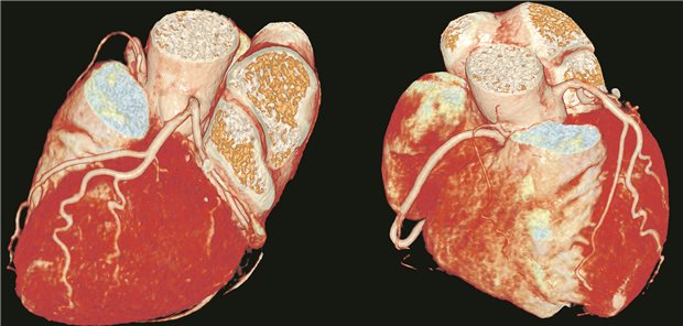 Aufnahme des Herzens aus der CT-Angiographie
