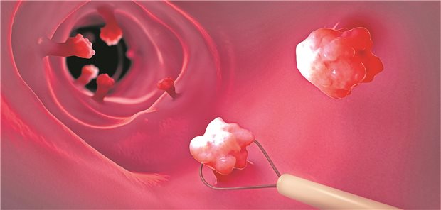 Bei einer Koloskopie können suspekte Polypen direkt entfernt werden. (3D-Illustration)